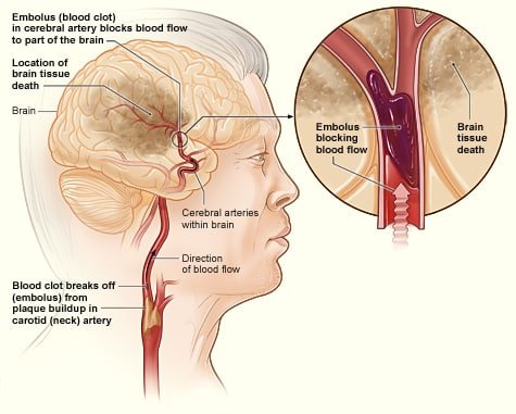 stroke affecting right side