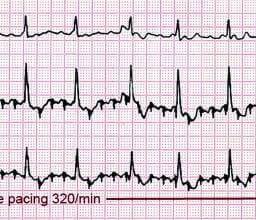 The Basics of Atrial Flutter | Healing Heart Disease Naturally (HHDN)